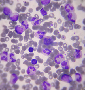 Transplante de medula óssea na Doença de Huntington