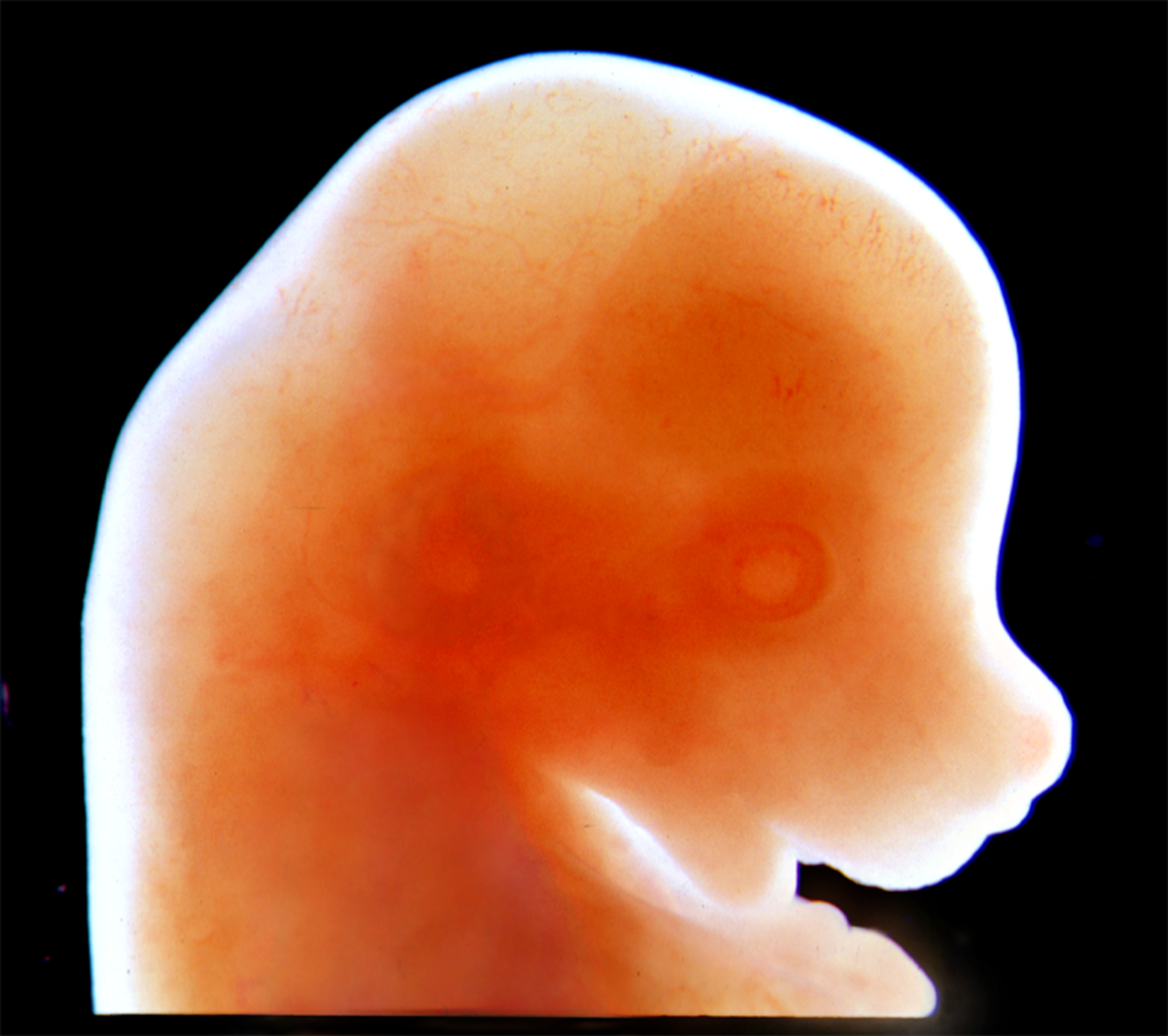 A exposição precoce à proteína HD pode causar sintomas ao longo da vida